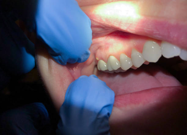 Best Emergency Tooth Extraction in Dobson, NC